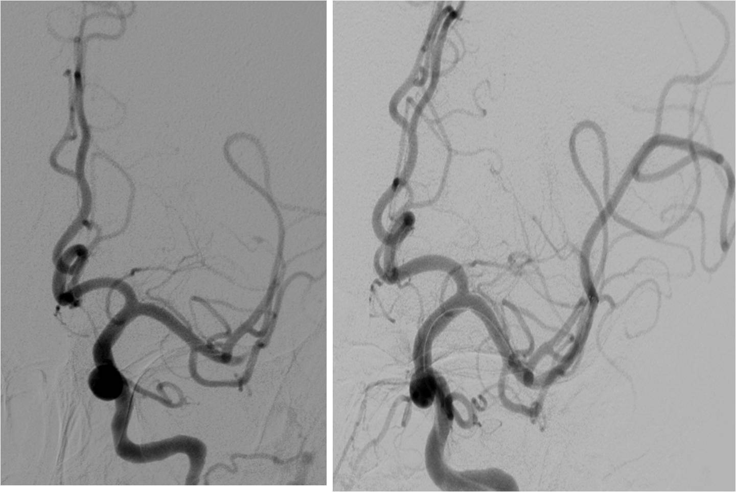急性缺血性脑卒中血管内治疗,缺血性脑血管病的抗血小板药治疗