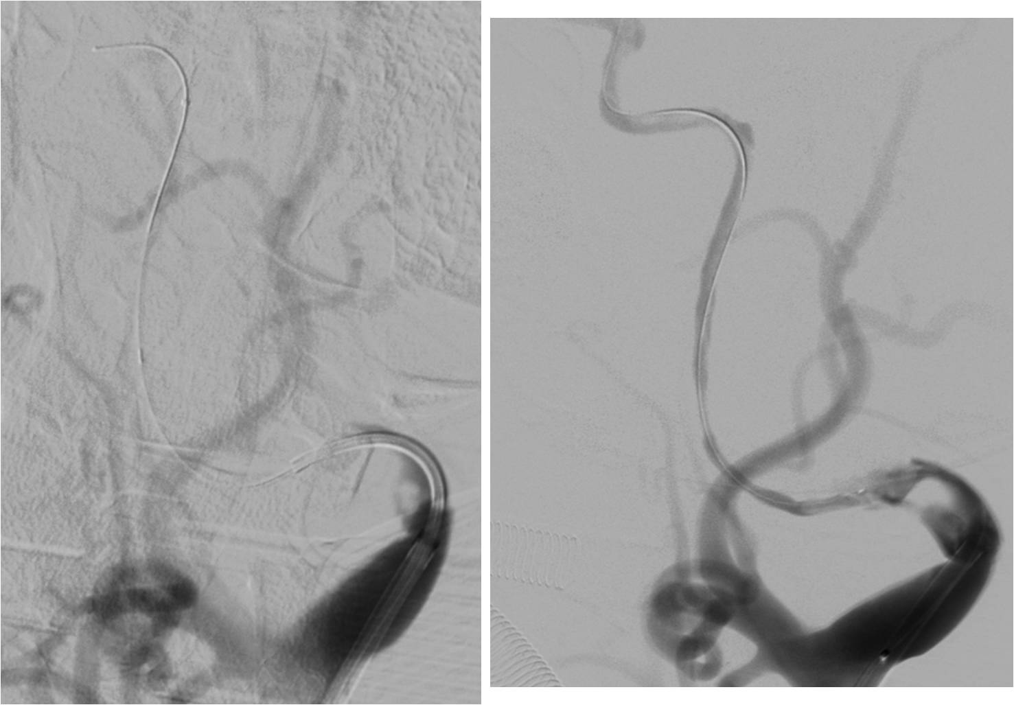 急性缺血性脑卒中血管内治疗,缺血性脑血管病的抗血小板药治疗