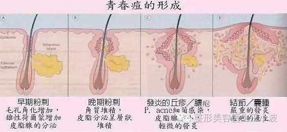 疮疡的病怎样治疗,疮疡是什么病引起的