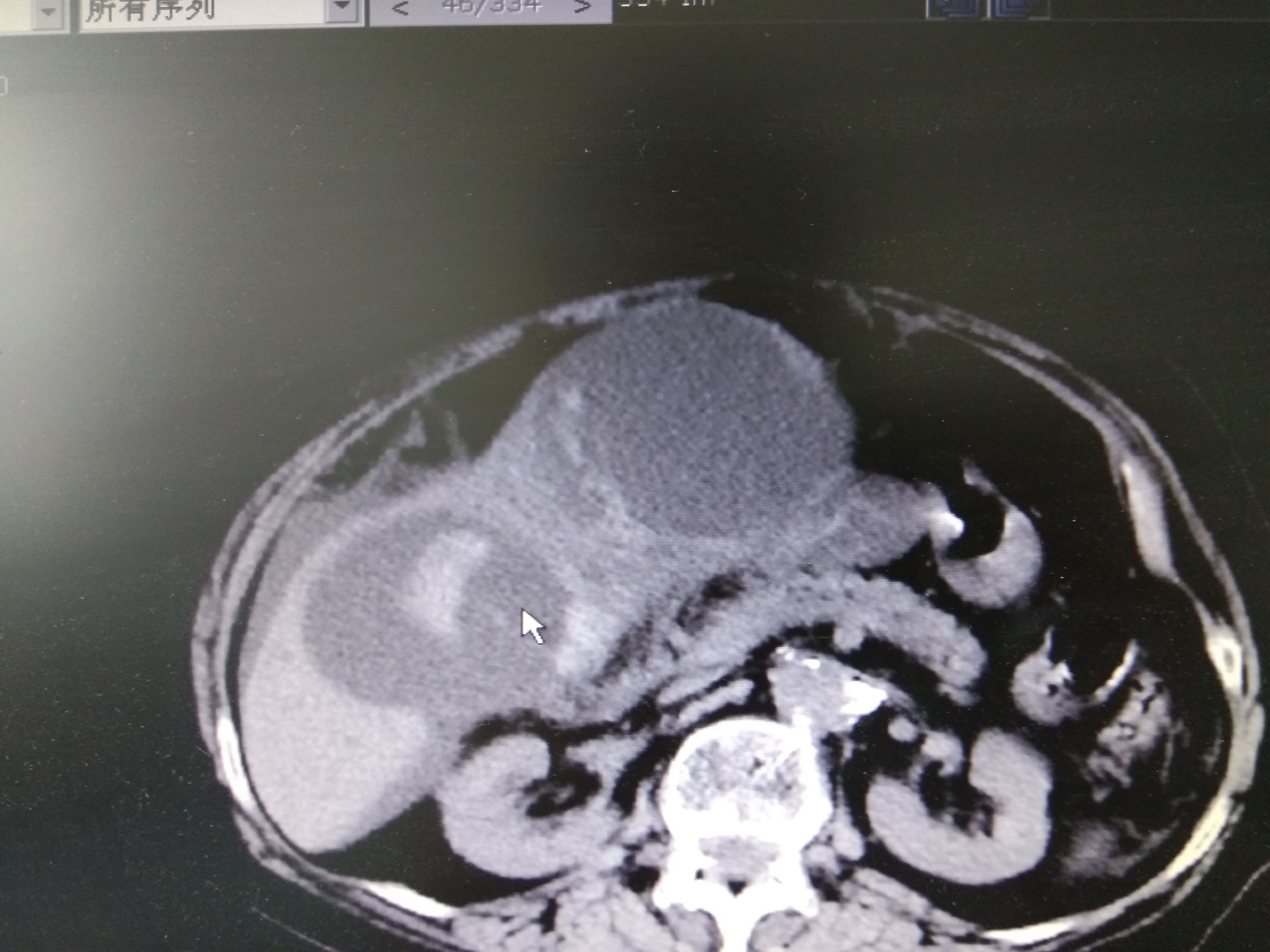 她被检查出患癌晚期,小医院查出肝囊肿有可能是癌吗