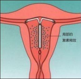 上环后有什么症状和危害,女性上环真对身体不好吗