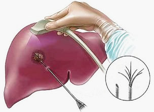 小肝癌手术后会不复发吗,肝癌手术后复发怎么治疗