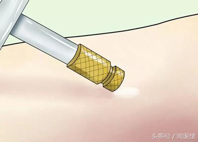 疤痕修复包括痘疤,刀疤跟痘疤哪种恢复快