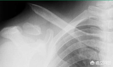 小孩骨折保守治疗不用药水的吗,为什么儿童骨折医生建议保守治疗