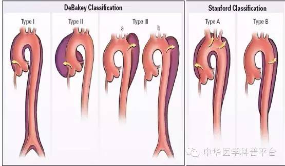 主动脉夹层什么症状,心脏主动脉夹层破裂
