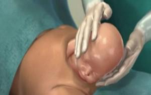 分娩时进行“剖腹产”手术全过程（附图）