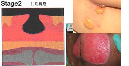 褥疮的护理和治疗方法,褥疮最怕的克星