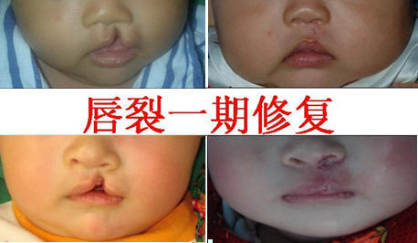 新生儿轻微兔唇是怎么造成的,生娃防坑指南