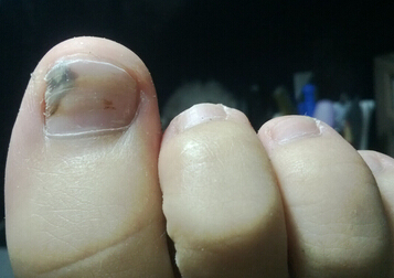 灰指甲的致病原因,灰指甲颜色呈黑色