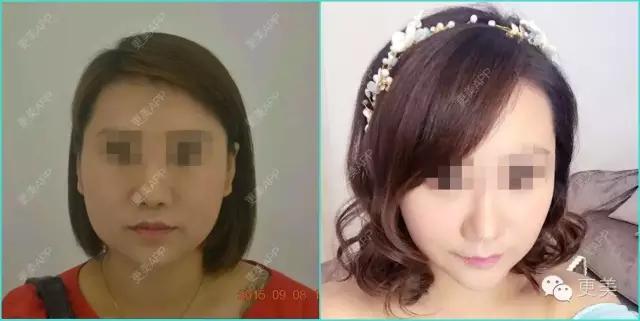 什么瘦脸霜最快最有效,瘦脸霜有用吗