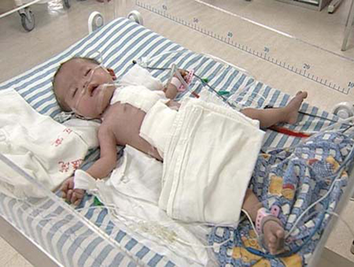 先天愚型宝宝可以治疗吗,先天愚型的新生儿有哪些表现