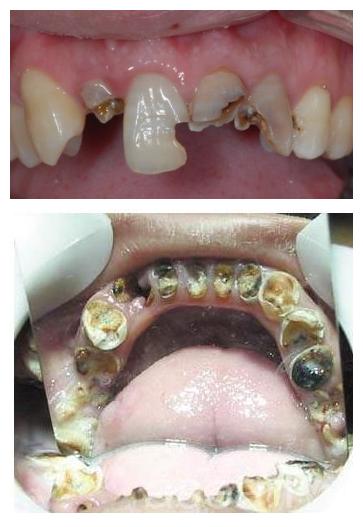 牙齿烂到不能补了,牙齿烂到不能补了怎么办