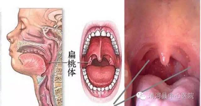 小孩扁桃体发炎切除还是不切,切扁桃体不切腺体