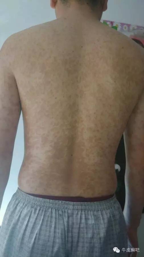 医院专家教你治疗牛皮癣,专家专治牛皮癣方法