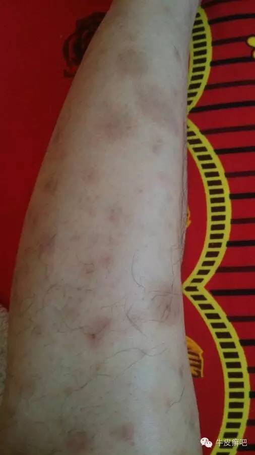 医院专家教你治疗牛皮癣,专家专治牛皮癣方法