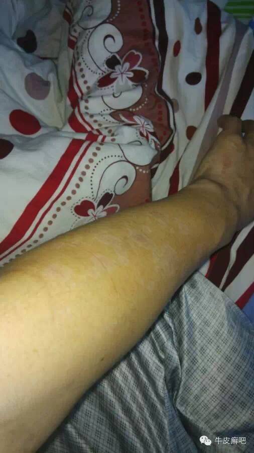 医院专家教你治疗牛皮癣,专家专治牛皮癣方法