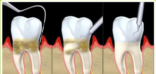 牙结石为什么用手抠不掉,自己抠牙结石能抠干净吗
