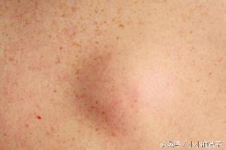 九个月宝宝手臂上起了个脓包,9个月宝宝手臂里面有个硬疙瘩