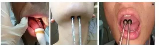 周惠嫦主任：鼻咽癌放疗后吞咽康复治疗的方法