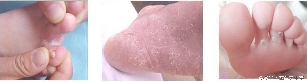 脚上脱皮红疱疹怎么根治,脚上反复起水泡脱皮开裂怎么治疗