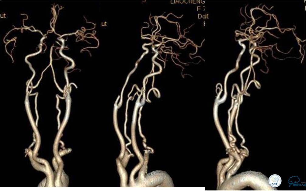 冠状动脉慢性闭塞的介入治疗,颅外段锥动脉狭窄的介入治疗
