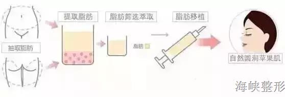 玻尿酸丰唇后恢复原样图片,玻尿酸丰鼻会变宽的对比照