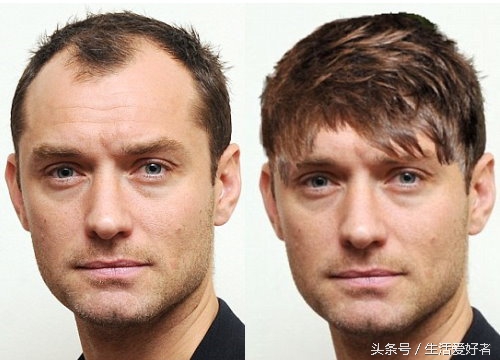 男士口碑最好的防脱生发产品,治疗男性脱发的药物排行榜前十名