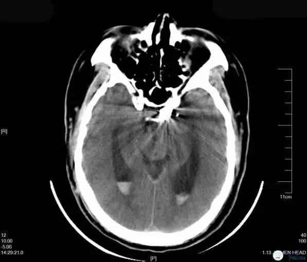 床突旁动脉瘤的血管内治疗