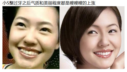 高圆圆戴牙套前后对比,高圆圆牙齿矫正牙套戴了几年