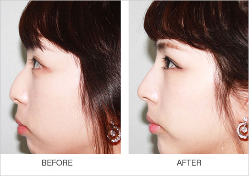 玻尿酸隆鼻的效果到底怎么样啊,玻尿酸隆鼻是不是适合每个人