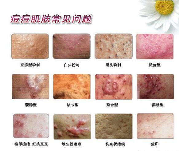 青春痘怎么不用药治愈好,青春痘才不是青春的专属