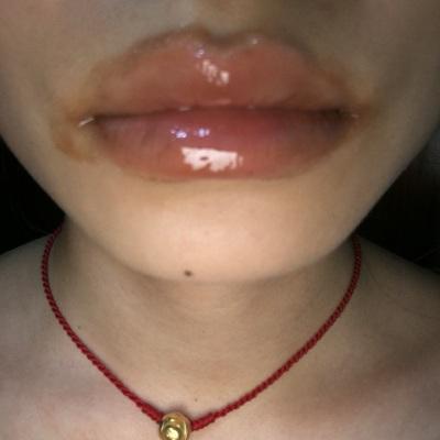 剥脱性唇炎最佳治疗方法,剥脱性唇炎吃什么食物好得快