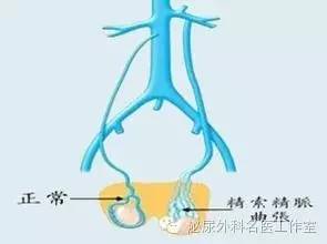 有小孩了还需要做精索静脉曲张吗,有小孩了重度精索静脉曲张
