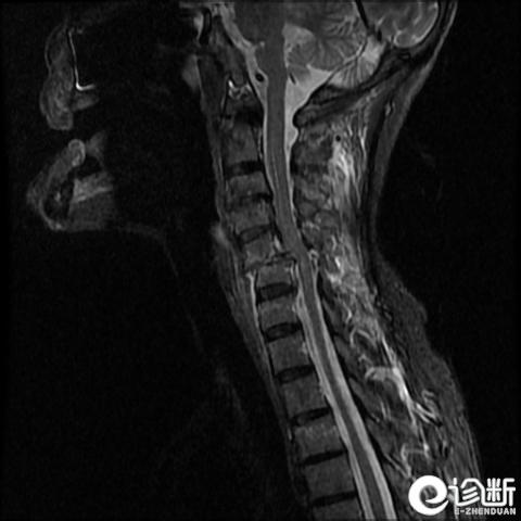 颈椎第五节骨折治疗成功的案例,颈椎骨折的诊断分析