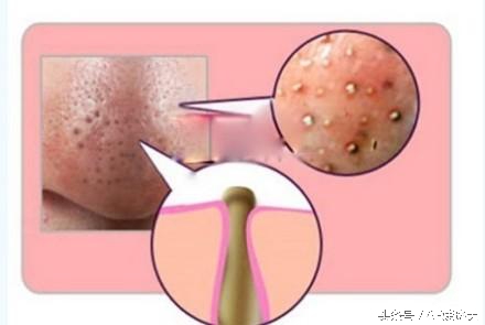 痘痘越来越可怕,记录痘痘生长全过程