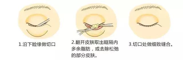 眼袋和卧蚕和泪沟的区别,你能不能搞清楚自己需要的是什么