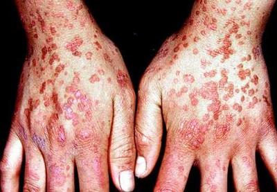 中医火针疗法治疣,中医实战笔记扁平疣秘方