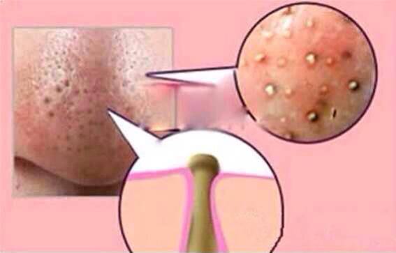 去黑头小技巧外国人,去黑头不需要任何工具的方法