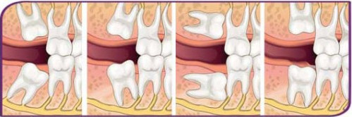 智齿牙龈肿痛怎么办吃什么药,智齿牙龈肿痛怎么办快速自愈方法