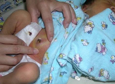 婴儿14天脐带未脱落有臭味,新生儿14天脐带未脱落
