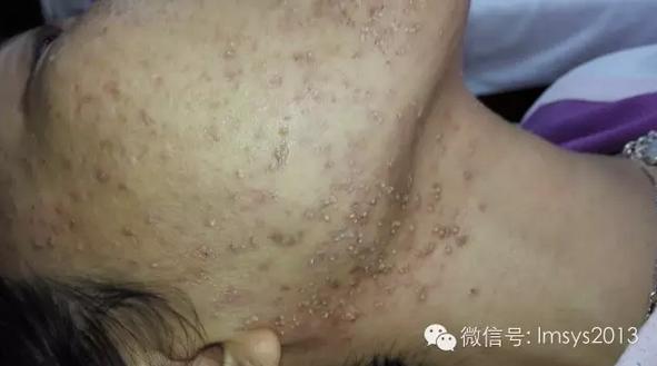 中医火针疗法治疣,中医实战笔记扁平疣秘方