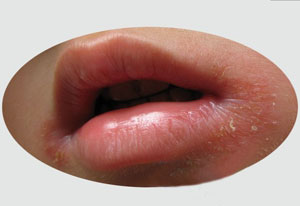 上火“走嘴”别轻视，其实是病毒感染