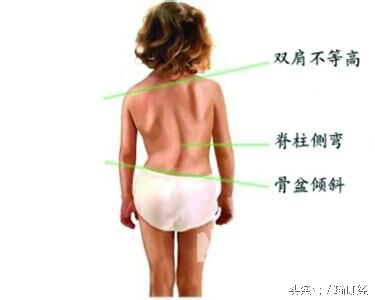 脊柱侧弯驼背怎么矫正,脊柱侧弯驼背怎么恢复