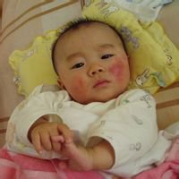 宝宝痱子抓破了怎么消除效果好,宝宝长脓疱疹要擦什么药