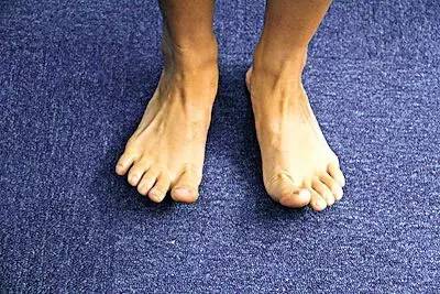 跑步足底筋膜炎后期如何康复训练,足底筋膜炎穿什么鞋跑步