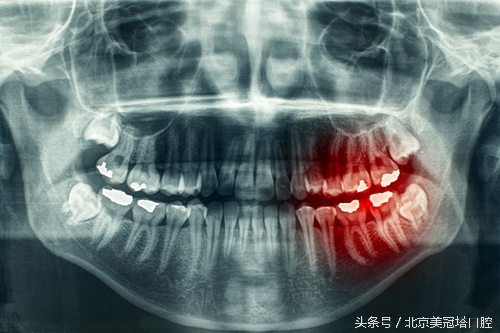 牙齿遇酸甜冷热就酸痛吃什么药,牙齿冷热酸甜不敢咬东西怎么办