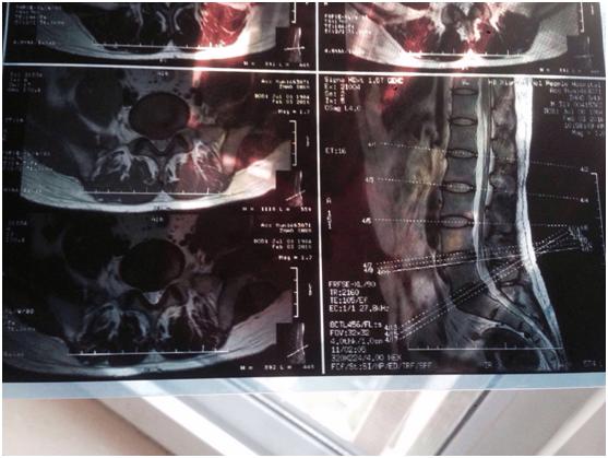 微医在线问诊可以约手术吗,九年的腰椎间盘突出能不能做微创