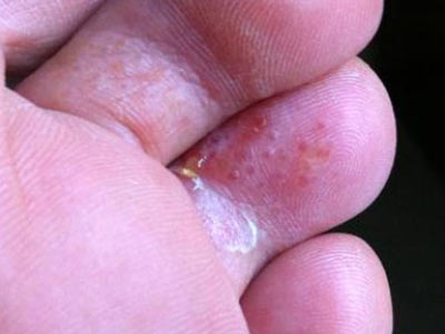 脚气脚臭脚痒便宜又好用的药,治脚气脚痒脚臭最有效的方法