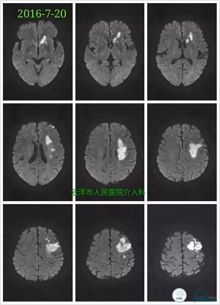 脑血管介入培训基地,脑卒中血管介入治疗