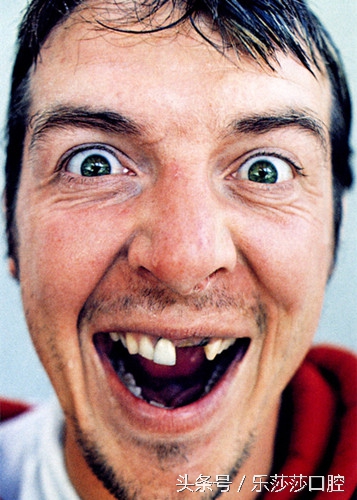 孩子玩闹时把大门牙磕掉了怎么办,十岁孩子门牙磕掉一块该怎么治疗